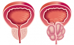 全面了解前列腺-前列腺，别作妖了！